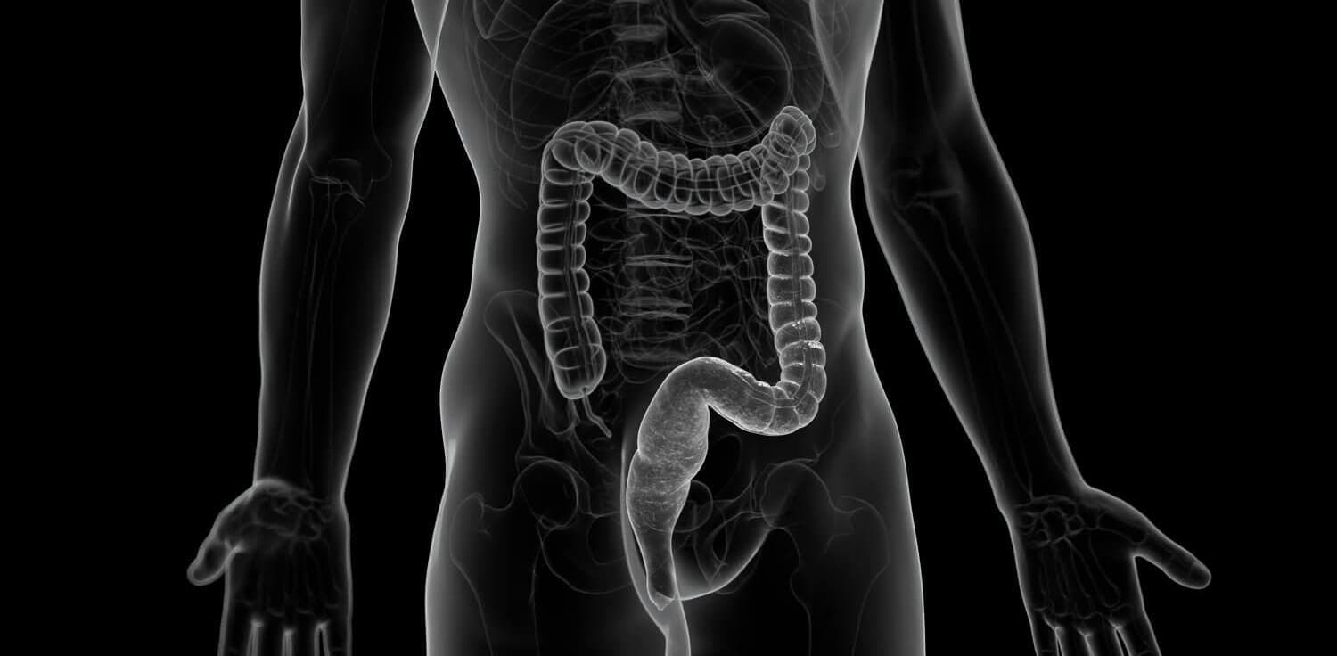 Colitis