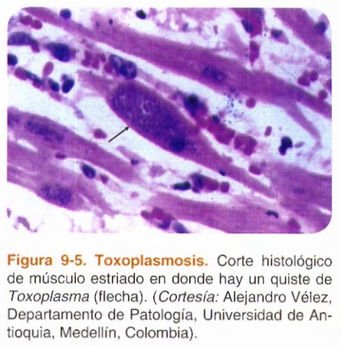 Músculo con toxoplasma gondii